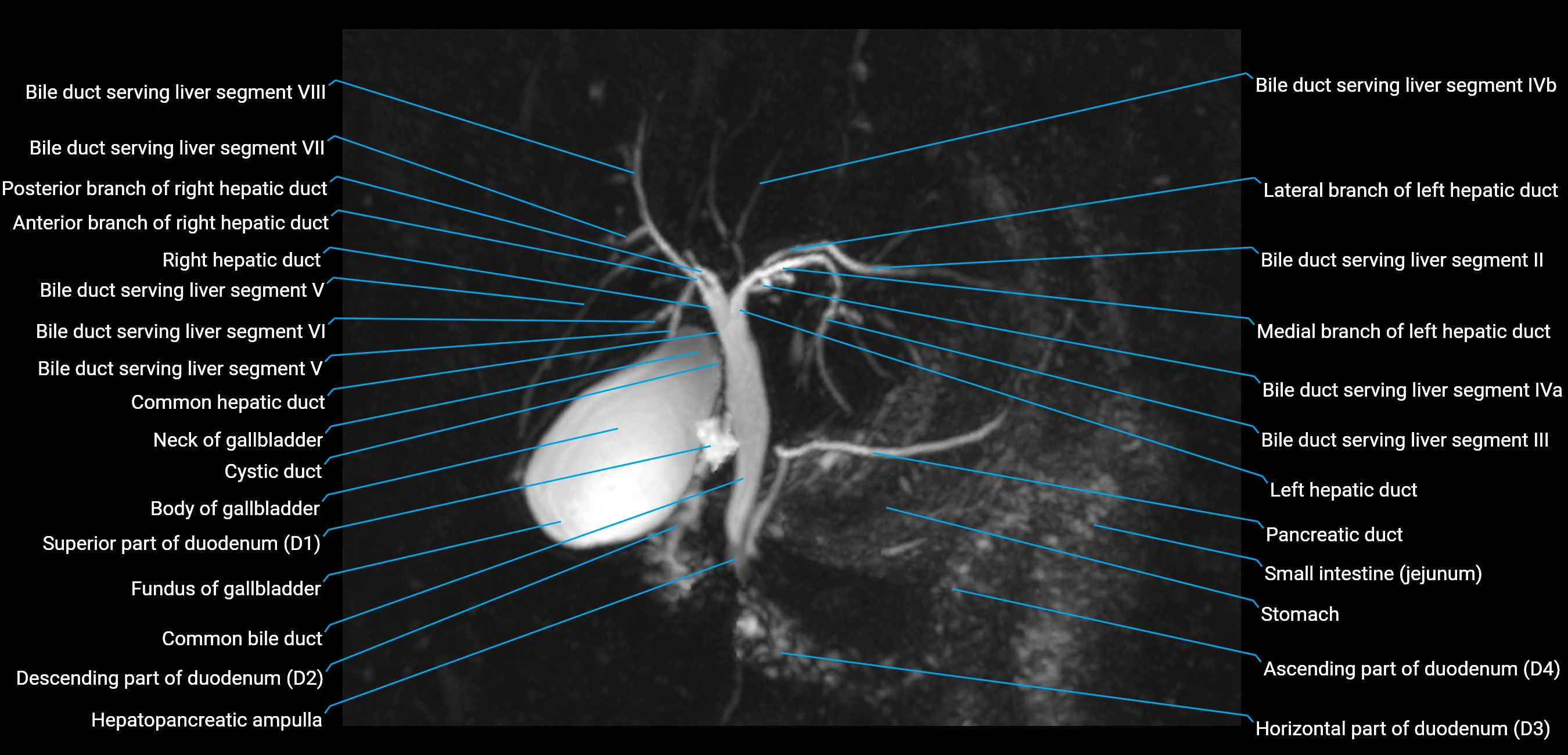 MRCP MIP MRI  anatomy labelled image-img-01003-00013.webp